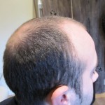 Male Hairloss Before Treatment